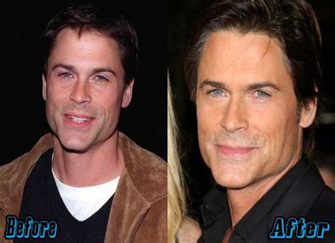 Has Rob Lowe Had Plastic Surgery? Exploring the Possibilities and Public Speculations